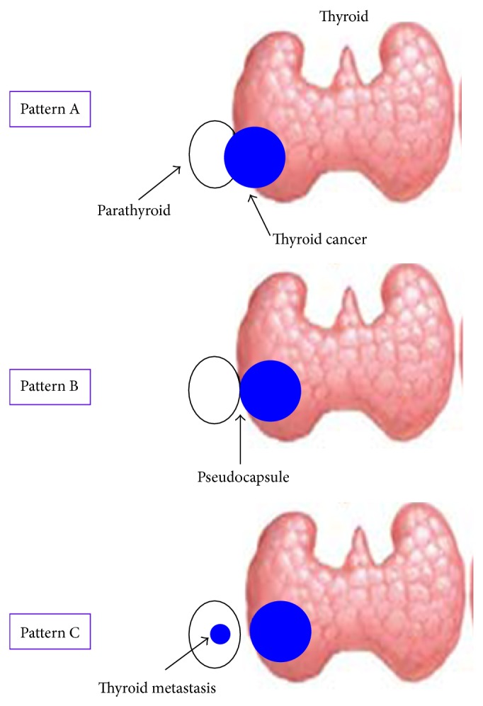 Parathyroid gland involvement by thyroid cancer: results from a large series of thyroidectomies performed in two italian university hospitals and review of the literature.