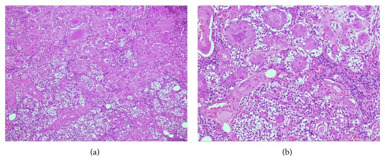 Parathyroid gland involvement by thyroid cancer: results from a large series of thyroidectomies performed in two italian university hospitals and review of the literature.