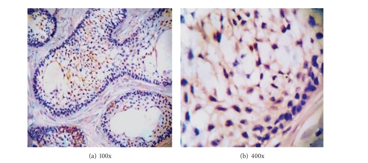 Calretinin as a diagnostic adjunct for ameloblastoma.