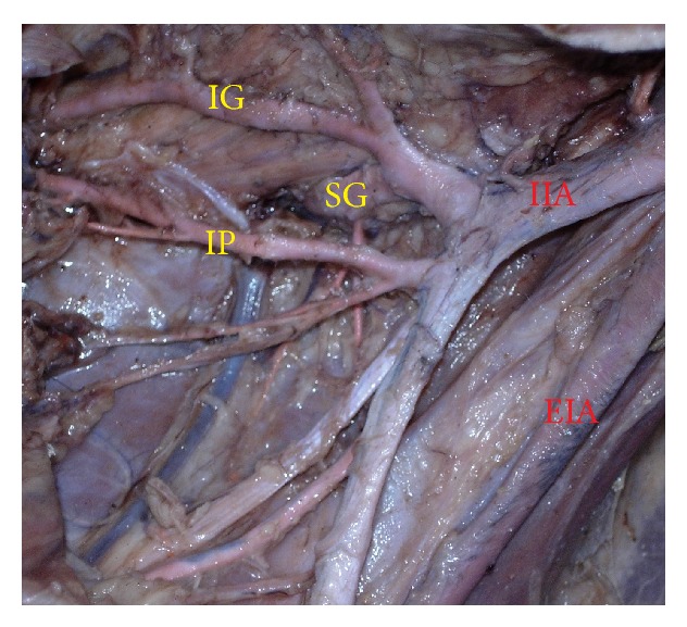 Variability in the branching pattern of the internal iliac artery in Indian population and its clinical importance.