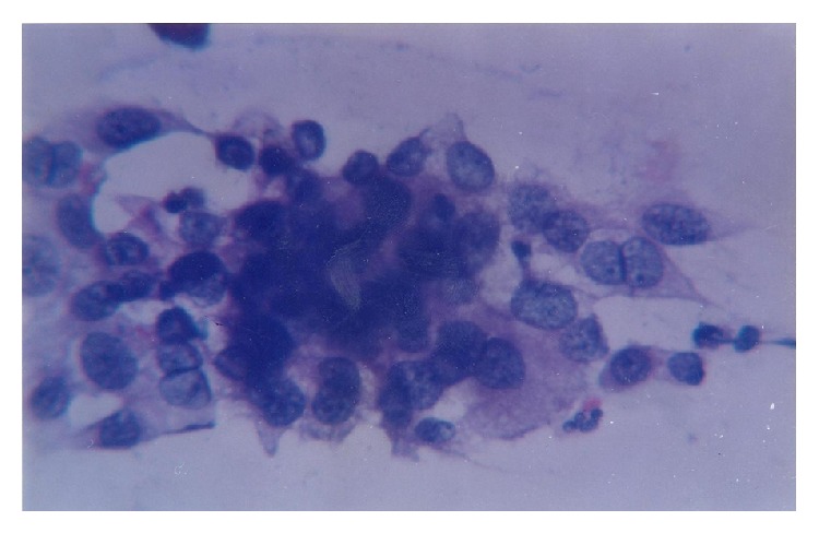 Prevalence of Trichomoniasis, Vaginal Candidiasis, Genital Herpes, Chlamydiasis, and Actinomycosis among Urban and Rural Women of Haryana, India.