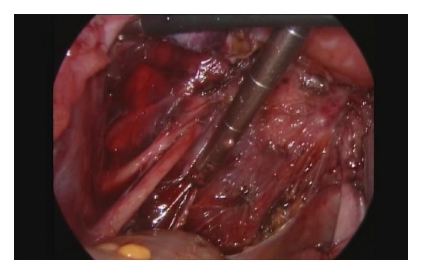 Posterior Deep Infiltrating Endometriotic Nodules: Operative Considerations according to Lesion Size, Location, and Geometry, during One's Learning Curve.