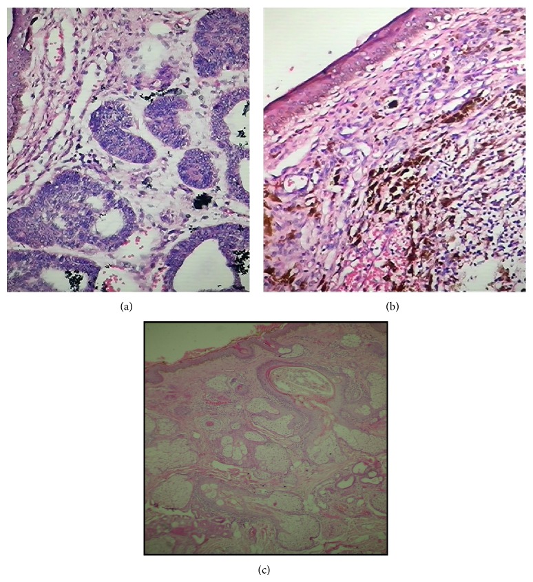 A study of Basal cell carcinoma in South asians for risk factor and clinicopathological characterization: a hospital based study.