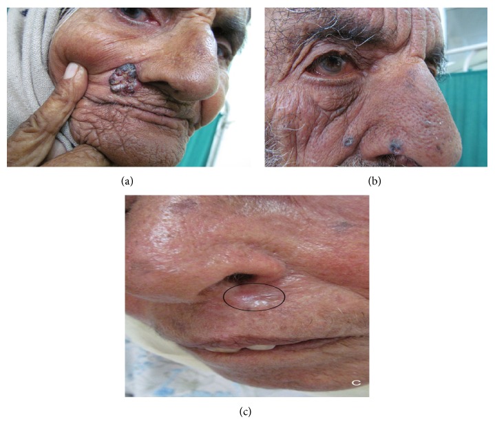 A study of Basal cell carcinoma in South asians for risk factor and clinicopathological characterization: a hospital based study.