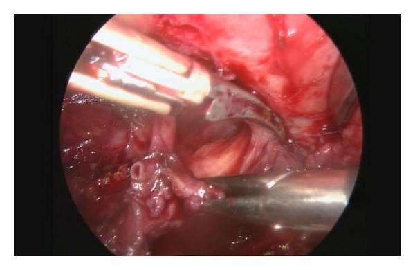 Posterior Deep Infiltrating Endometriotic Nodules: Operative Considerations according to Lesion Size, Location, and Geometry, during One's Learning Curve.