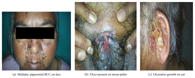 A study of Basal cell carcinoma in South asians for risk factor and clinicopathological characterization: a hospital based study.