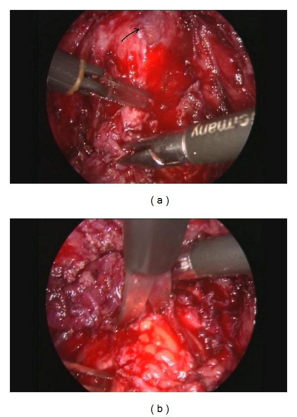 Posterior Deep Infiltrating Endometriotic Nodules: Operative Considerations according to Lesion Size, Location, and Geometry, during One's Learning Curve.