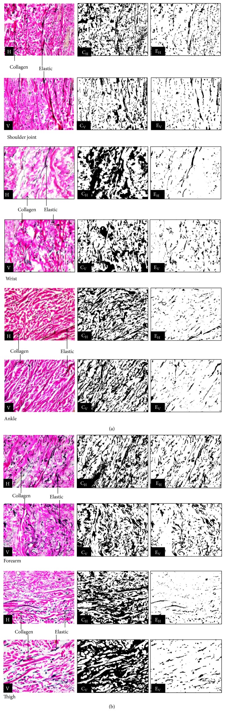 Surgical implications of asymmetric distribution of dermal collagen and elastic fibres in two orientations of skin samples from extremities.