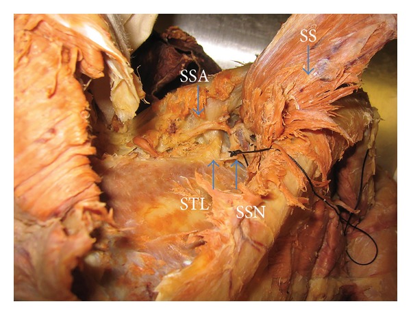Anatomical considerations of the suprascapular nerve in rotator cuff repairs.