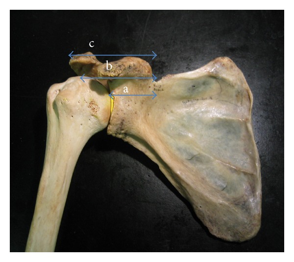 Anatomical considerations of the suprascapular nerve in rotator cuff repairs.