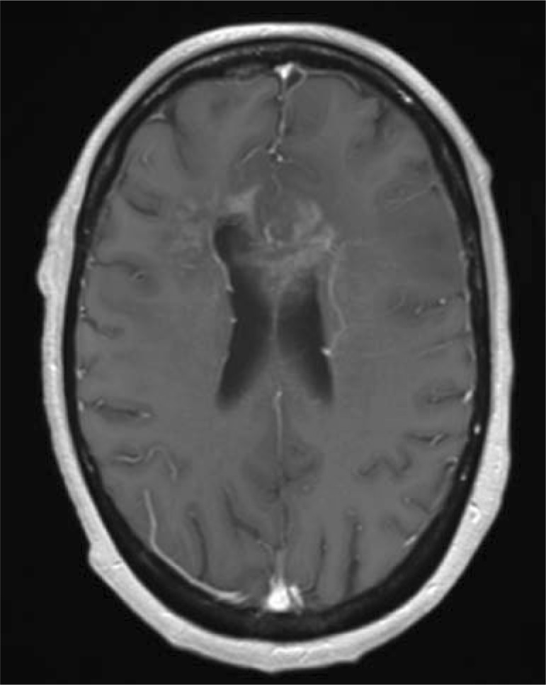 Standards of care and novel approaches in the management of glioblastoma multiforme.