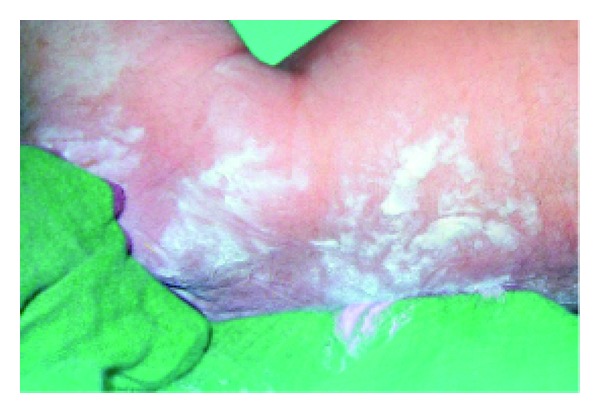 A cross-sectional prospective study of cutaneous lesions in newborn.