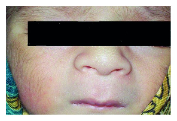 A cross-sectional prospective study of cutaneous lesions in newborn.