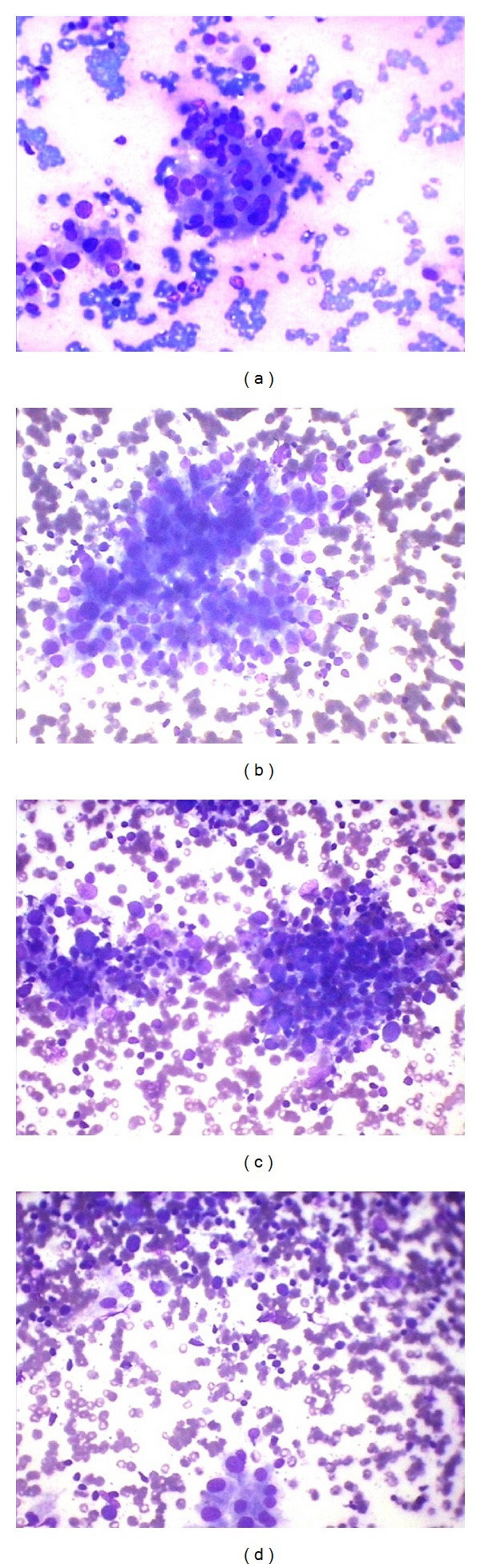 Correlation of fine needle aspiration cytology findings with thyroid function test in cases of lymphocytic thyroiditis.