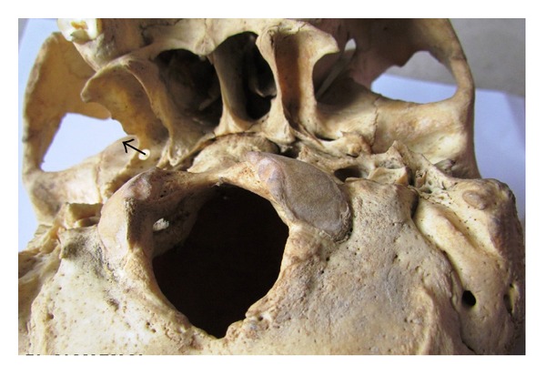 Pterygospinous bar and foramen in the adult human skulls of north India: its incidence and clinical relevance.