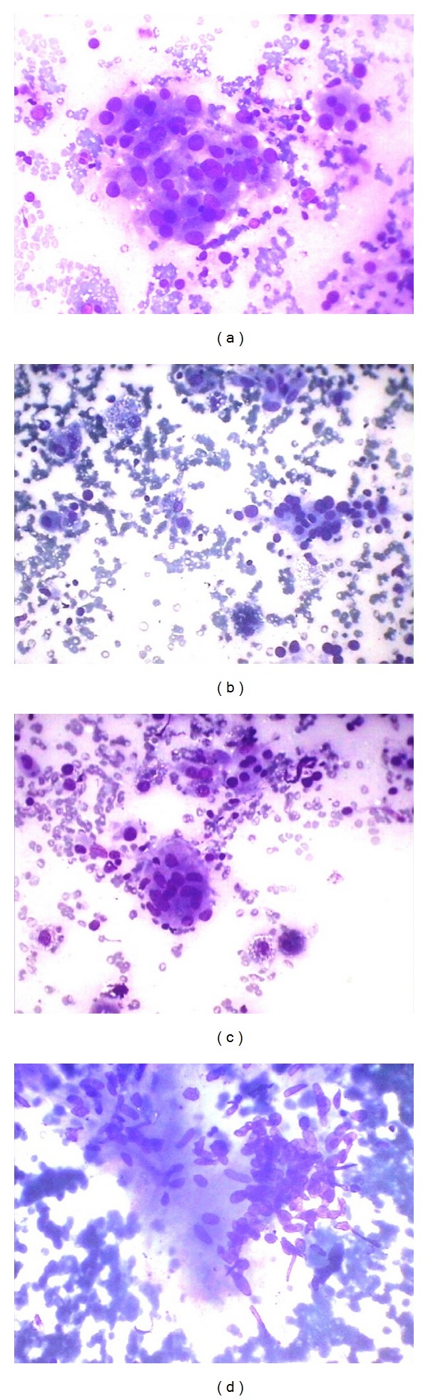 Correlation of fine needle aspiration cytology findings with thyroid function test in cases of lymphocytic thyroiditis.