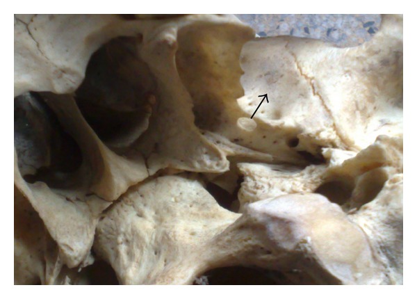 Pterygospinous bar and foramen in the adult human skulls of north India: its incidence and clinical relevance.