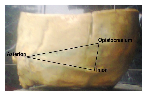 Sex Determination Using Inion-Opistocranium-Asterion (IOA) Triangle in Nigerians' Skulls.