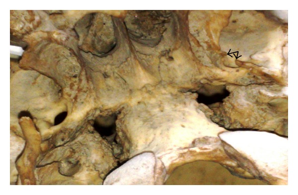 Pterygospinous bar and foramen in the adult human skulls of north India: its incidence and clinical relevance.