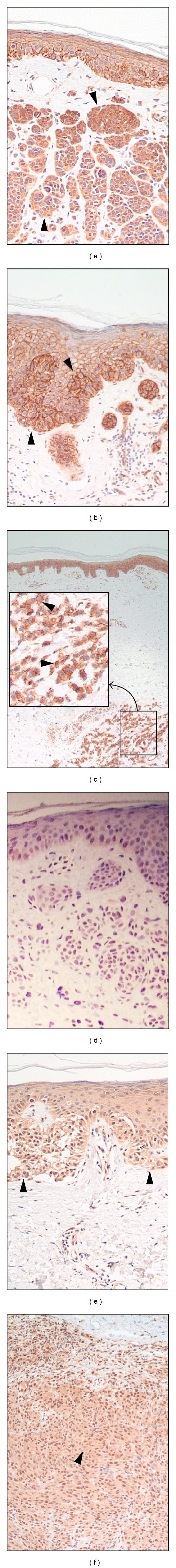 Melanoma Development and Progression Are Associated with Rad6 Upregulation and β -Catenin Relocation to the Cell Membrane.