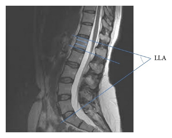 Relationship of the lumbar lordosis angle to the level of termination of the conus medullaris and thecal sac.