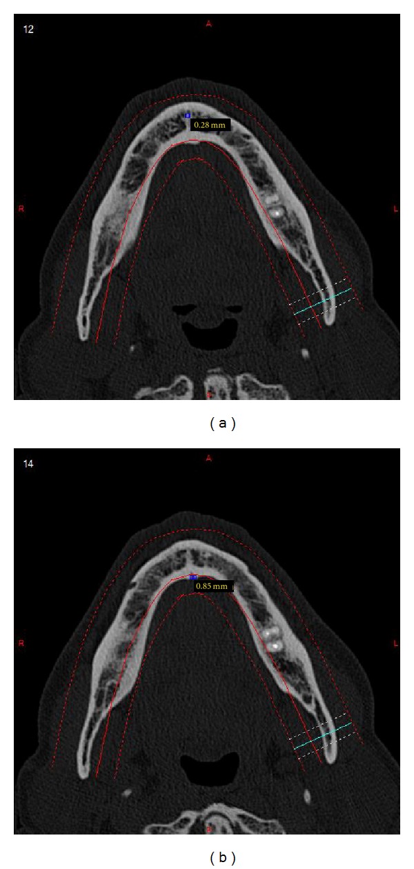 Anterior mandibular lingual foramina: an in vivo investigation.