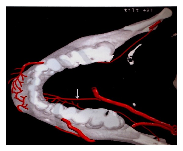 Anterior mandibular lingual foramina: an in vivo investigation.