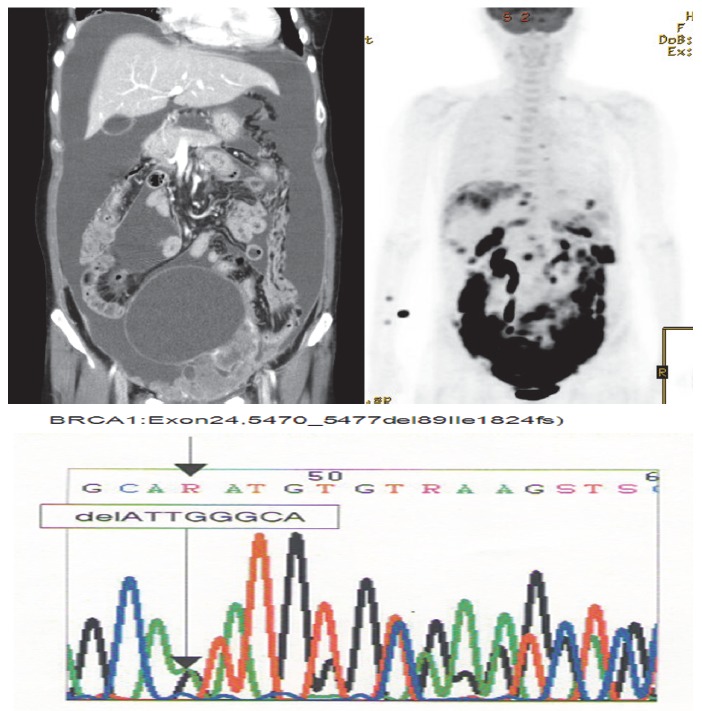 One Case of a BRCA1 Germ Line Mutation Ovarian Carcinoma Patient Based on Abnormal Immunohistochemistry Finding.