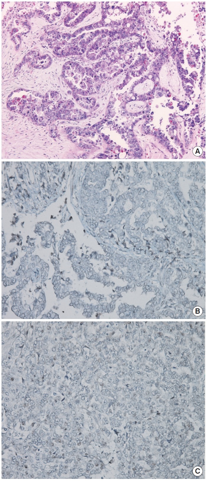 One Case of a BRCA1 Germ Line Mutation Ovarian Carcinoma Patient Based on Abnormal Immunohistochemistry Finding.