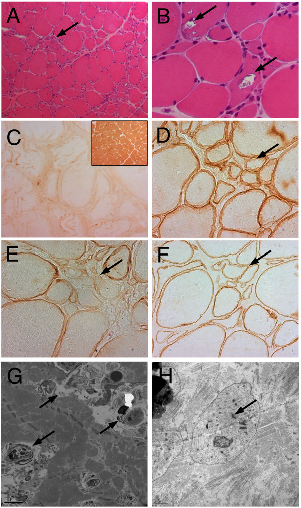 Limb girdle muscular dystrophy type 2G with myopathic-neurogenic motor unit potentials and a novel muscle image pattern.