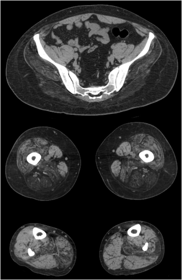 Limb girdle muscular dystrophy type 2G with myopathic-neurogenic motor unit potentials and a novel muscle image pattern.