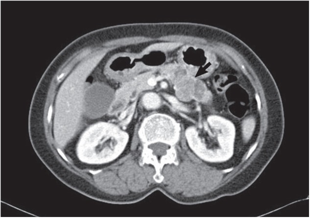 The limitations of endoscopic ultrasound-guided fine needle aspiration cytology in the diagnosis of pancreatic serous cystadenoma: a brief case report.