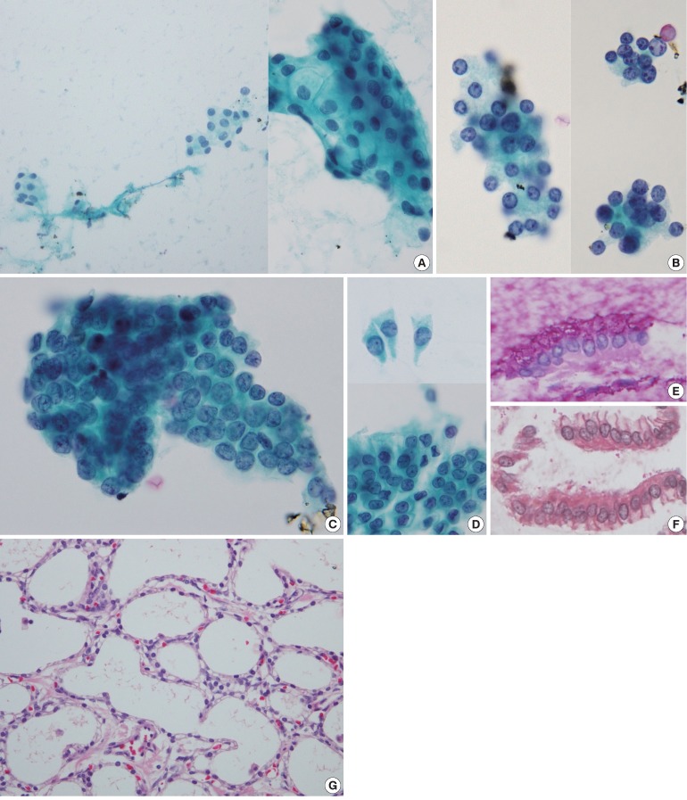 The limitations of endoscopic ultrasound-guided fine needle aspiration cytology in the diagnosis of pancreatic serous cystadenoma: a brief case report.