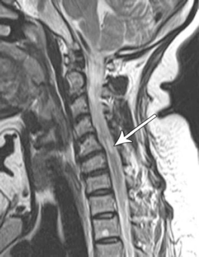 Spinal cord ischemia following cervical transforaminal epidural steroid injection.