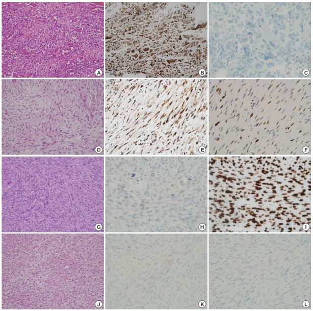 Mdm2 and p53 Expression in Radiation-Induced Sarcomas of the Head and Neck: Comparison with De Novo Sarcomas.