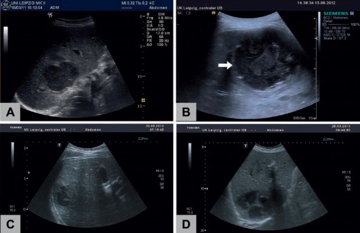 Therapy of Liver Abscesses.