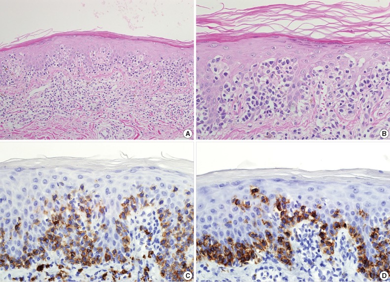 Cytotoxic Variant of Mycosis Fungoides with CD8+ CD56+ Phenotype: A Case Report and Review of Literature.