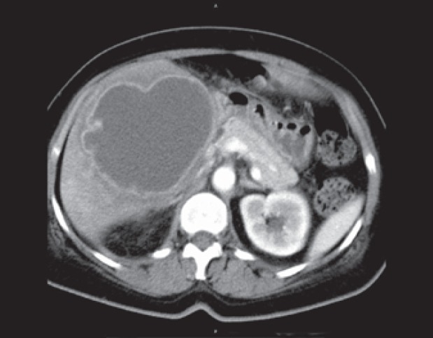 Therapy of Liver Abscesses.