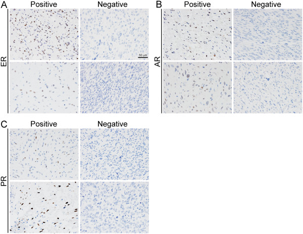 Estrogen receptor alpha and androgen receptor are commonly expressed in well-differentiated liposarcoma.