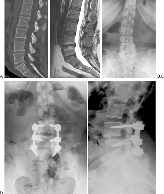 Microdiscectomy for the treatment of lumbar disc herniation: an evaluation of reoperations and long-term outcomes.