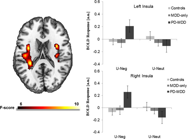 Insula response to unpredictable and predictable aversiveness in individuals with panic disorder and comorbid depression.