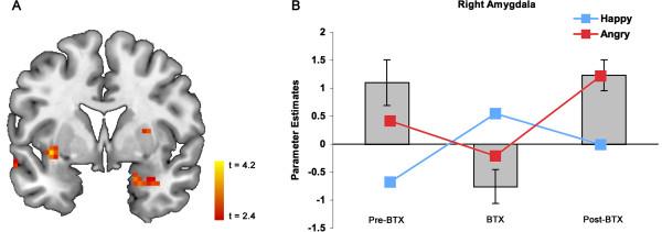 Botulinum toxin-induced facial muscle paralysis affects amygdala responses to the perception of emotional expressions: preliminary findings from an A-B-A design.