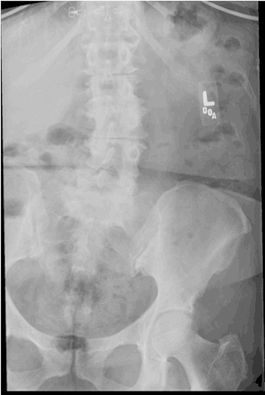 Sterile Seroma Resulting from Multilevel XLIF Procedure as Possible Adverse Effect of Prophylactic Vancomycin Powder: A Case Report.