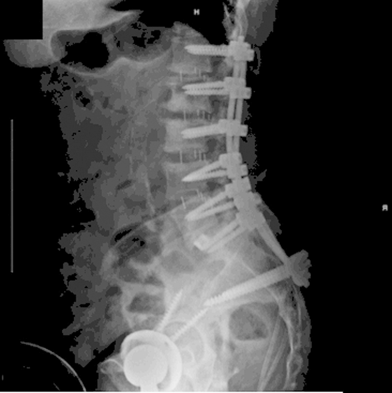 Sterile Seroma Resulting from Multilevel XLIF Procedure as Possible Adverse Effect of Prophylactic Vancomycin Powder: A Case Report.