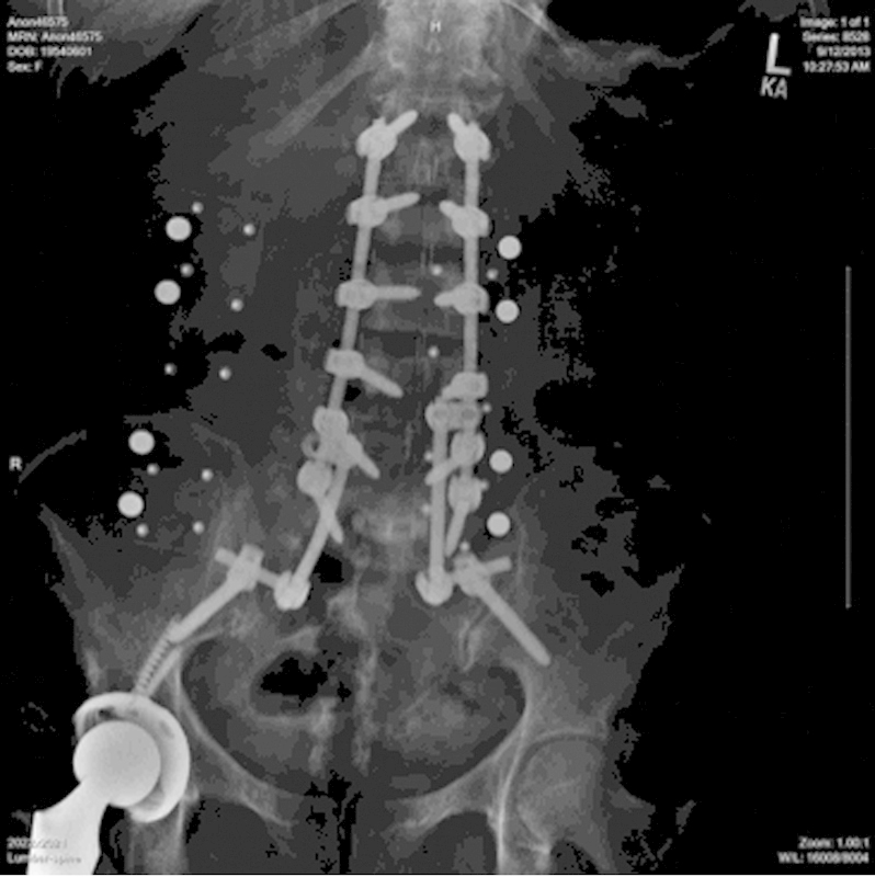 Sterile Seroma Resulting from Multilevel XLIF Procedure as Possible Adverse Effect of Prophylactic Vancomycin Powder: A Case Report.