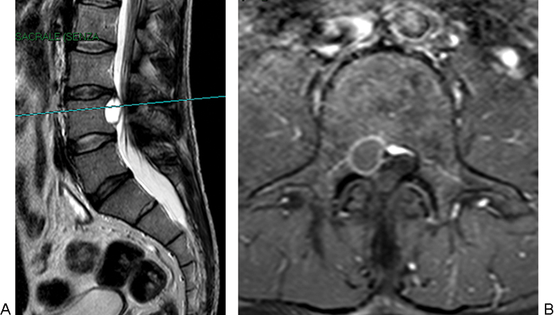 Lumbar intervertebral discal cyst: a rare cause of low back pain and radiculopathy. Case report and review of the current evidences on diagnosis and management.