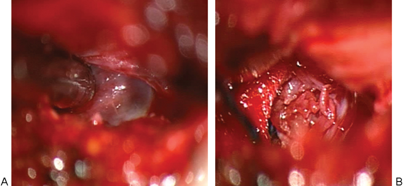 Lumbar intervertebral discal cyst: a rare cause of low back pain and radiculopathy. Case report and review of the current evidences on diagnosis and management.
