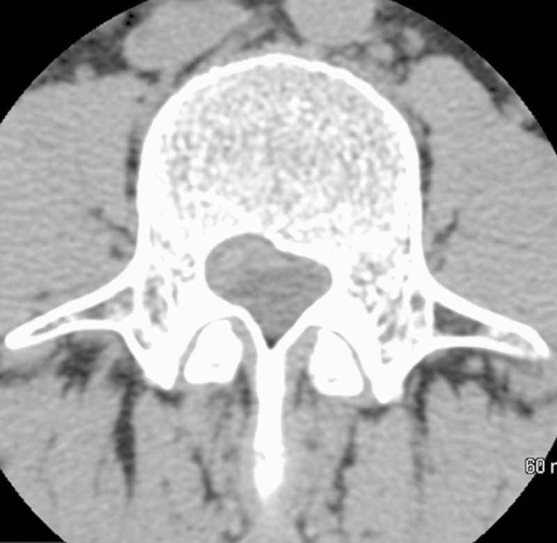 Lumbar intervertebral discal cyst: a rare cause of low back pain and radiculopathy. Case report and review of the current evidences on diagnosis and management.