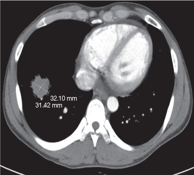 Pulmonary hodgkin lymphoma in a patient with Crohn's disease.