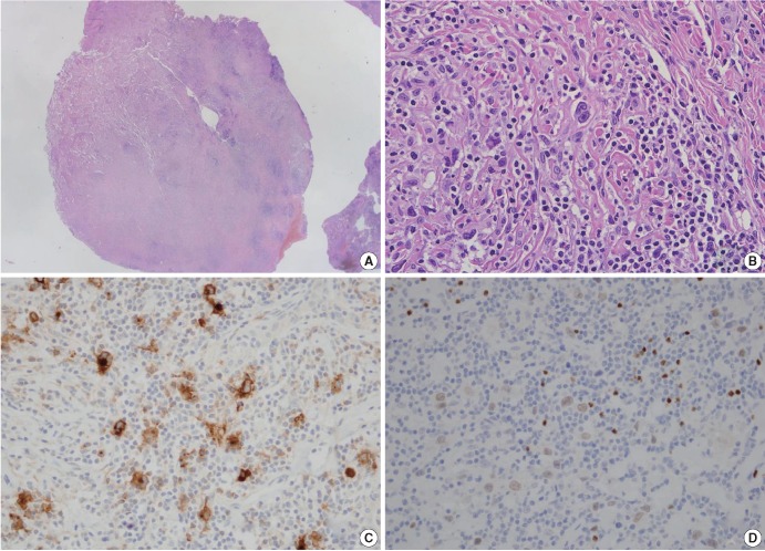 Pulmonary hodgkin lymphoma in a patient with Crohn's disease.